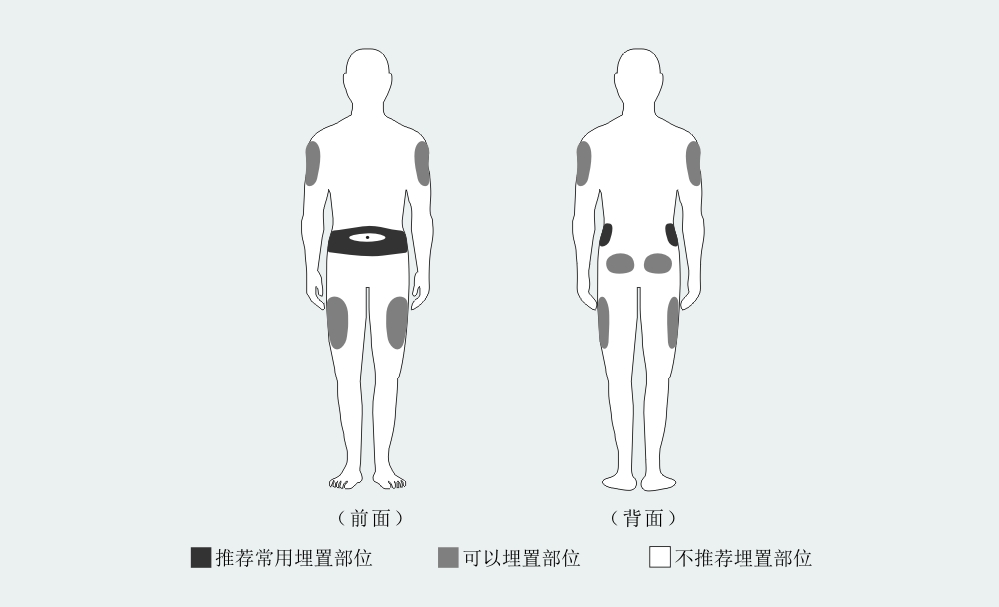 胰岛素泵佩戴部位2.jpg